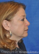 Caucasian/European Rhinoplasty - Case 100 - After