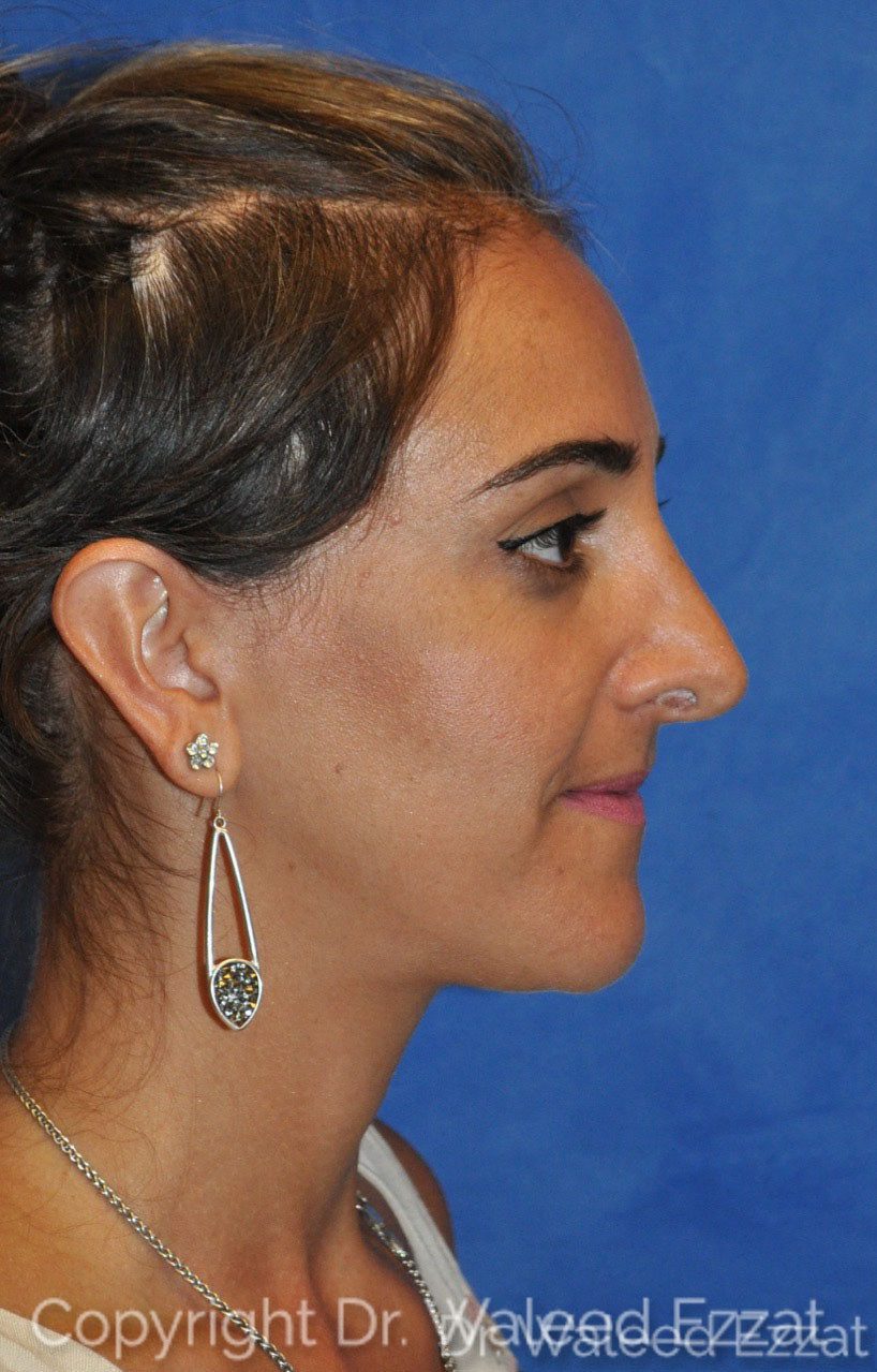 Hispanic/South American Rhinoplasty Patient Photo - Case 102 - before view-