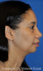 African/Caribbean Rhinoplasty - Case 200 - After