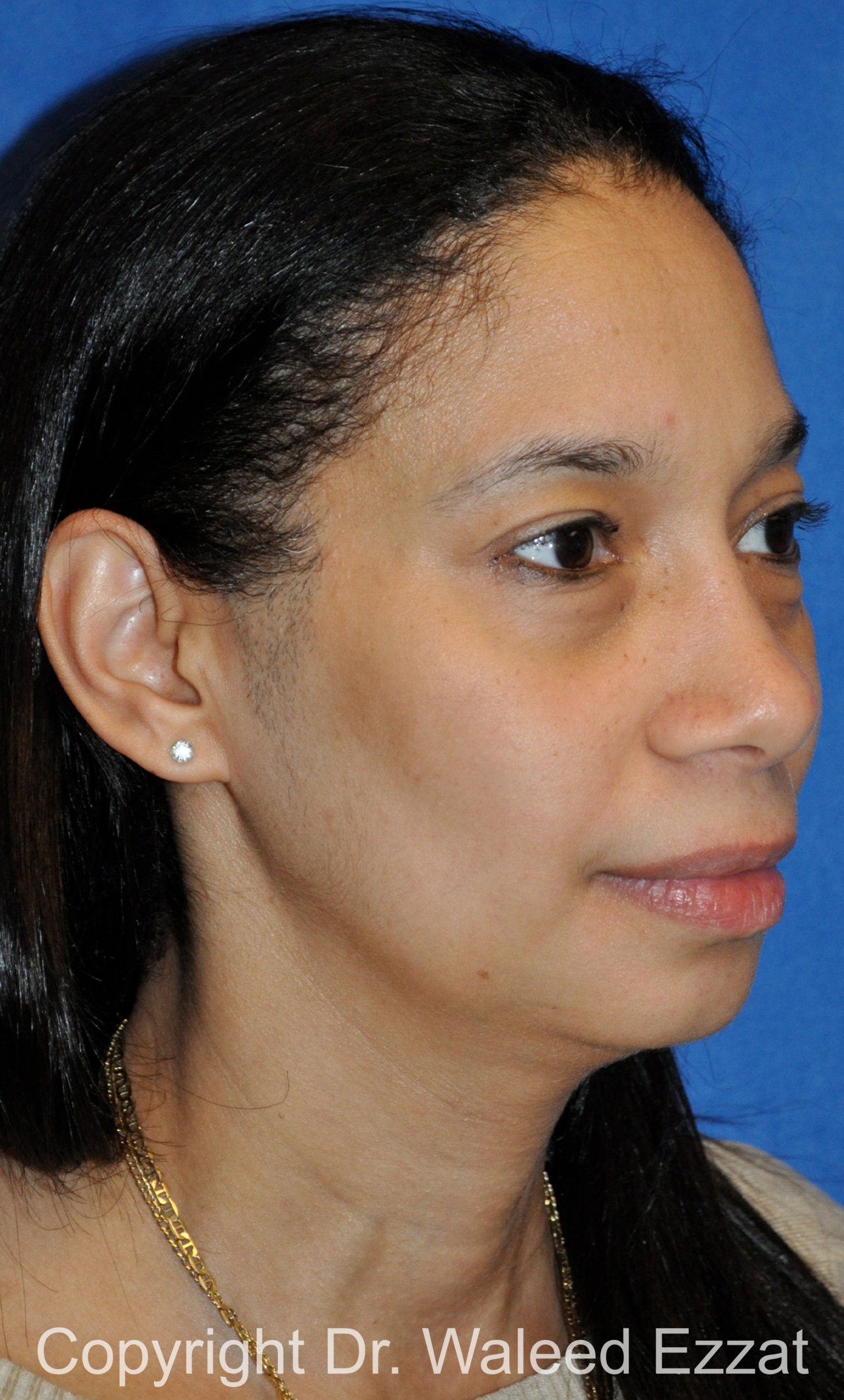 African/Caribbean Rhinoplasty Patient Photo - Case 200 - after view-1
