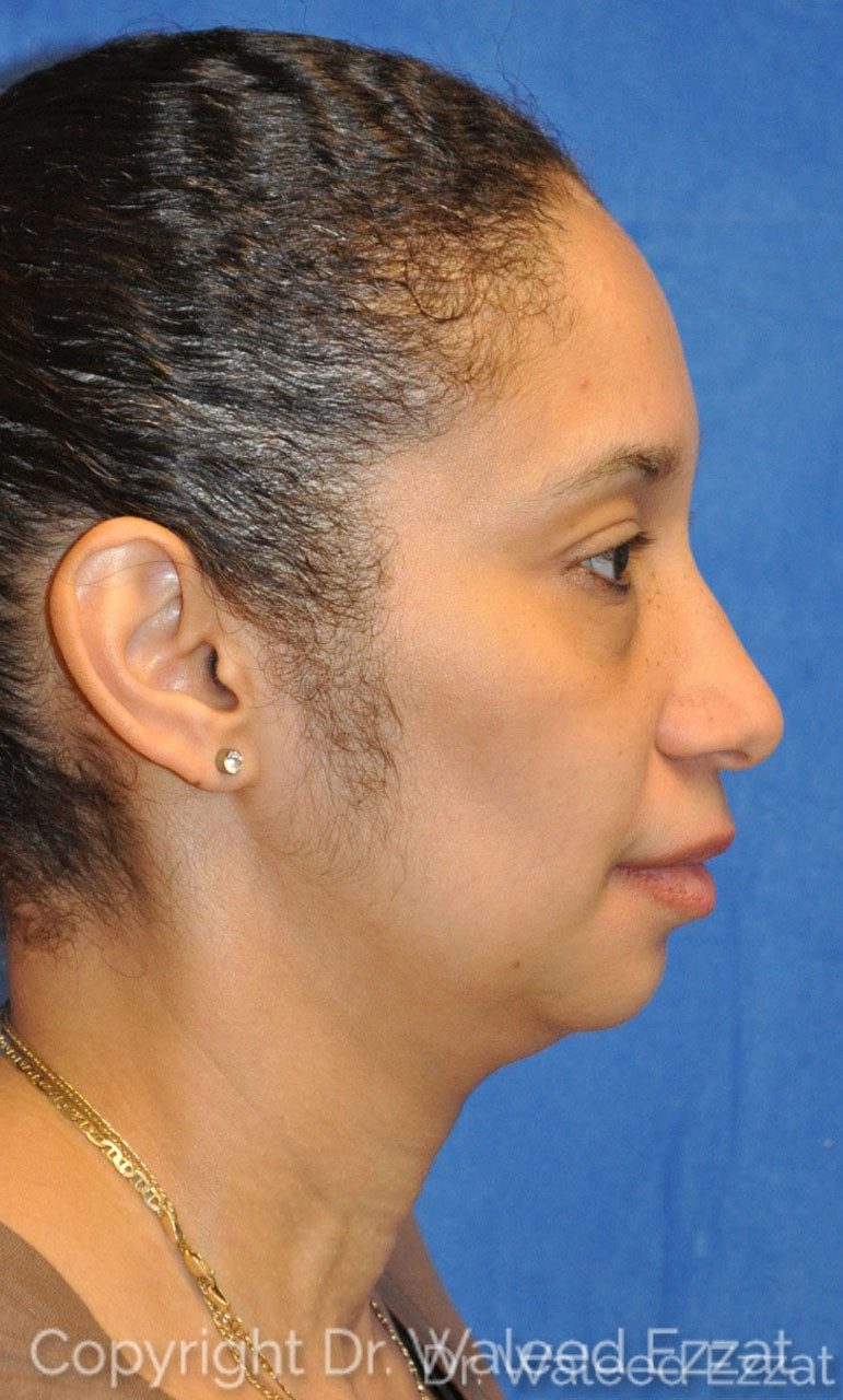 African/Caribbean Rhinoplasty Patient Photo - Case 1 - before view-