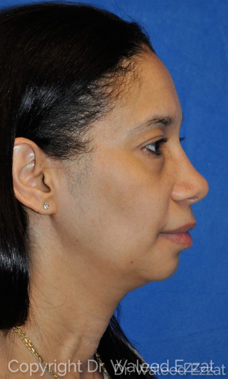African/Caribbean Rhinoplasty Patient Photo - Case 1 - after view