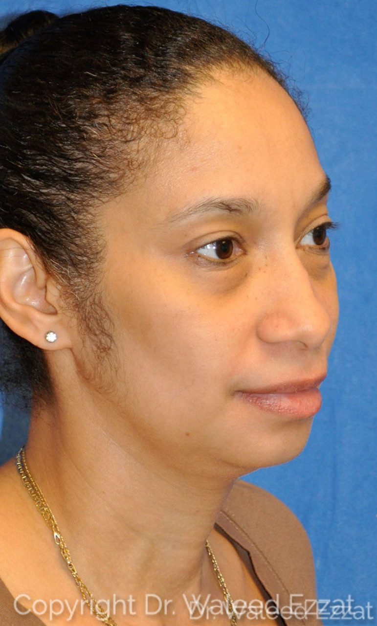 African/Caribbean Rhinoplasty Patient Photo - Case 1 - before view-2