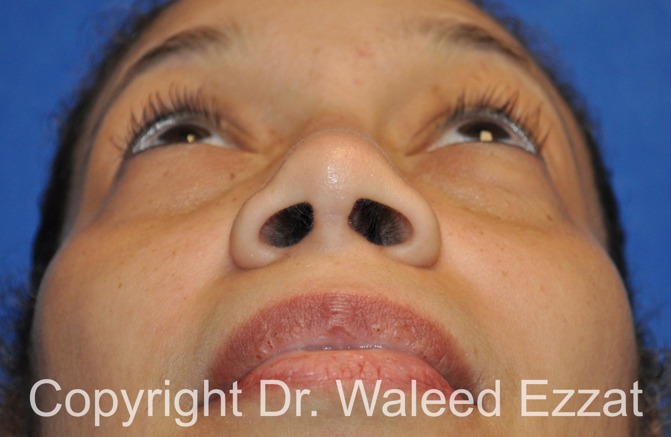 African/Caribbean Rhinoplasty Patient Photo - Case 200 - after view-3