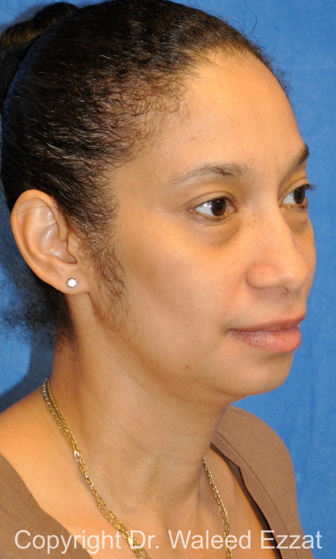 African/Caribbean Rhinoplasty Patient Photo - Case 200 - before view-1