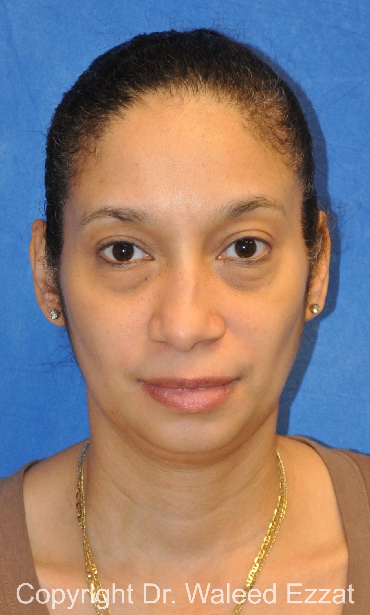 African/Caribbean Rhinoplasty Patient Photo - Case 200 - before view-2