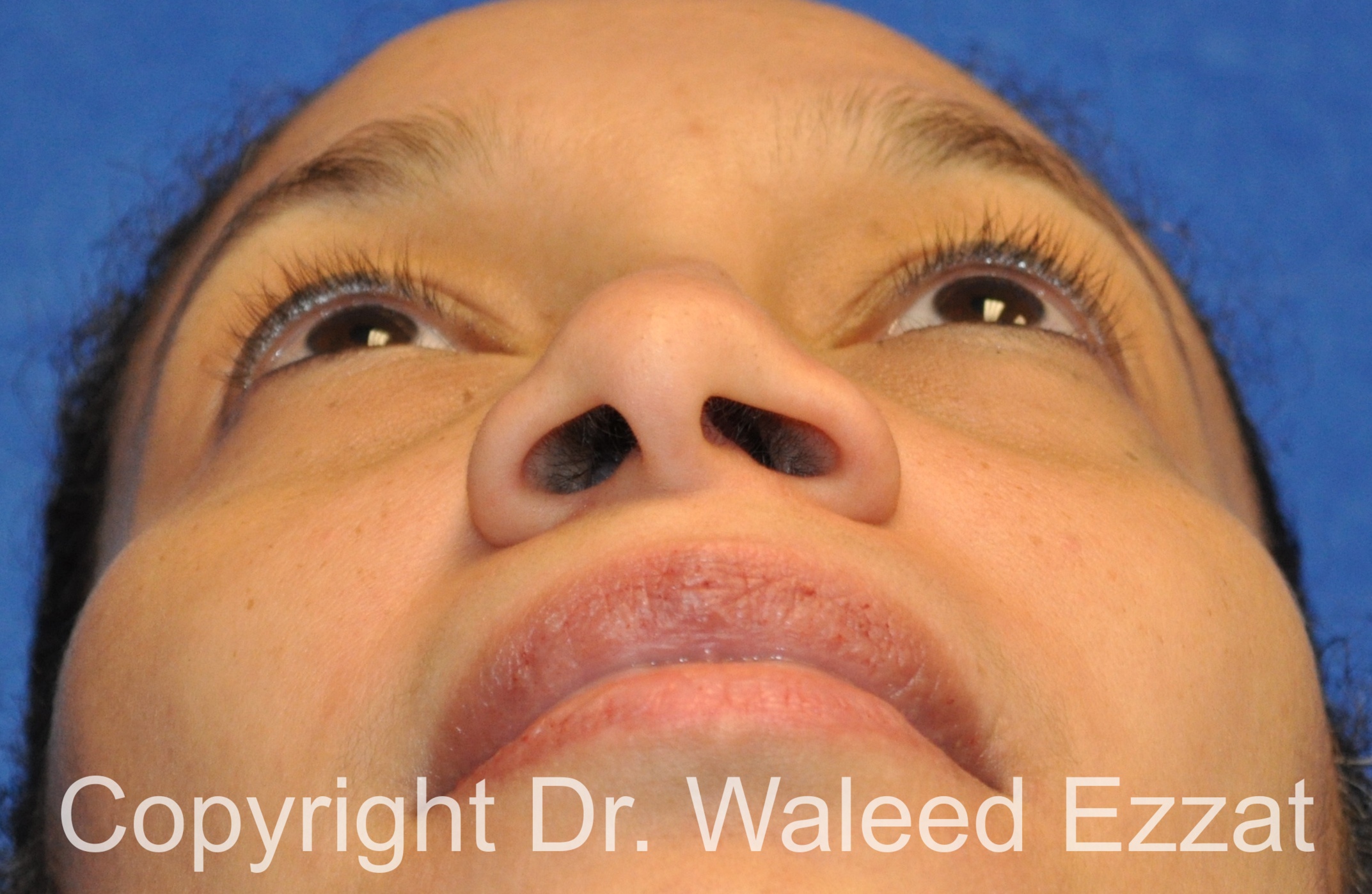African/Caribbean Rhinoplasty Patient Photo - Case 200 - before view-3