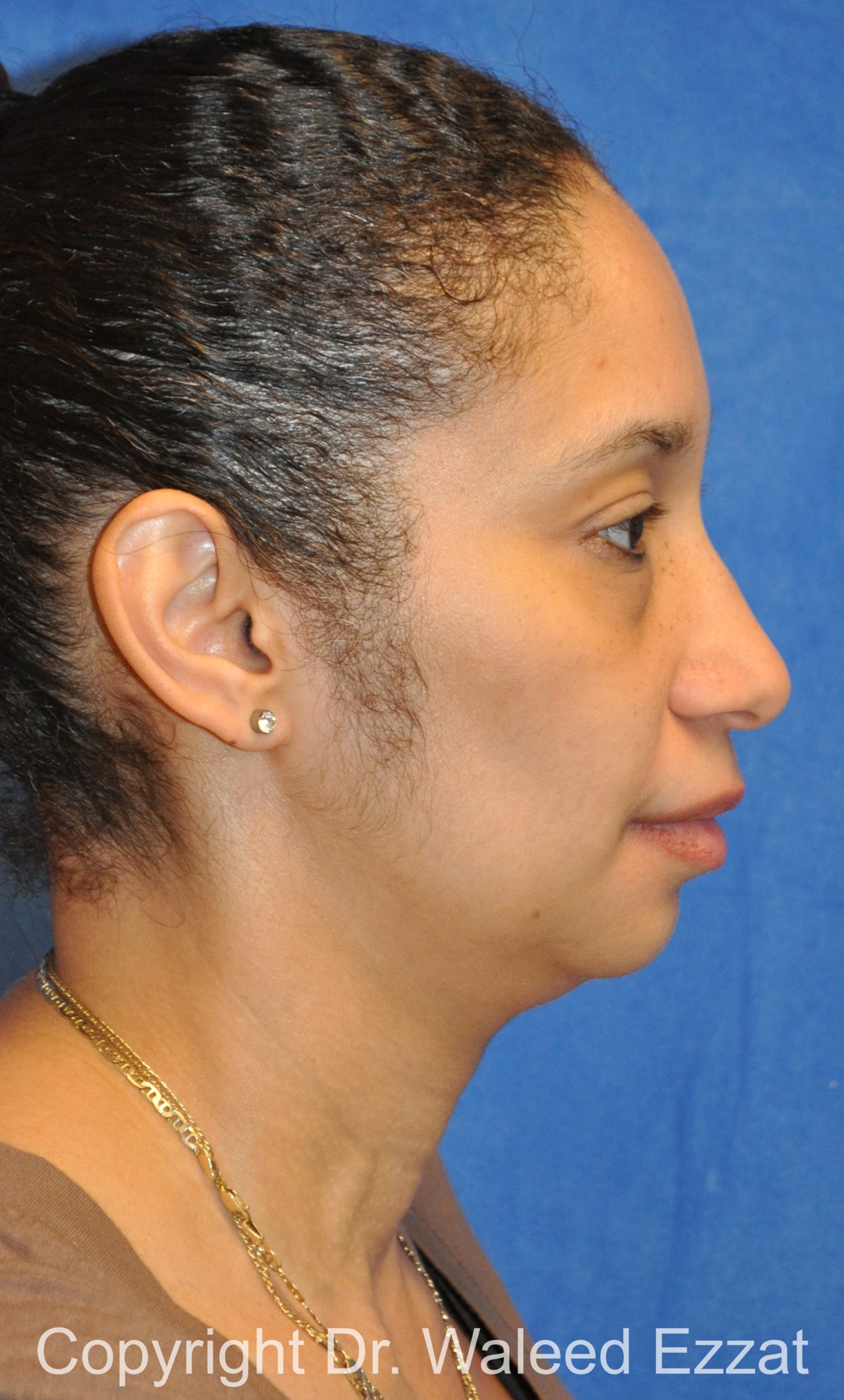 African/Caribbean Rhinoplasty Patient Photo - Case 200 - before view-