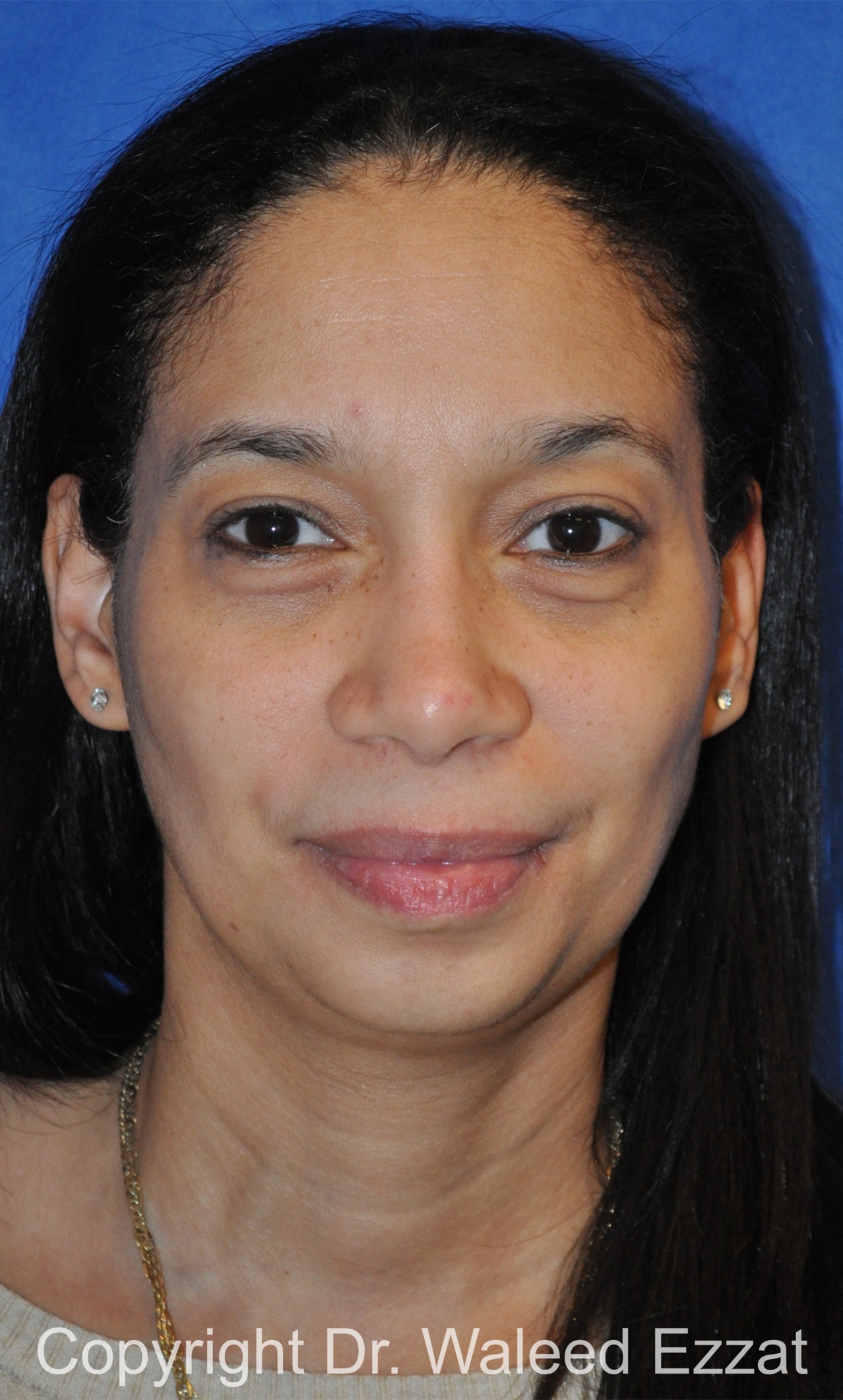 African/Caribbean Rhinoplasty Patient Photo - Case 200 - after view-2