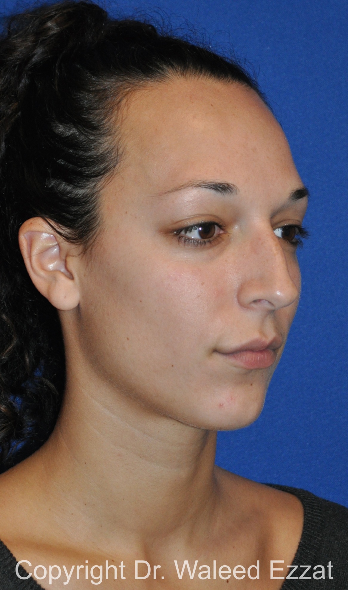 Mediterranean/Middle Eastern Rhinoplasty Patient Photo - Case 655 - before view-1