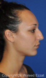 Mediterranean/Middle Eastern Rhinoplasty - Case 655 - Before