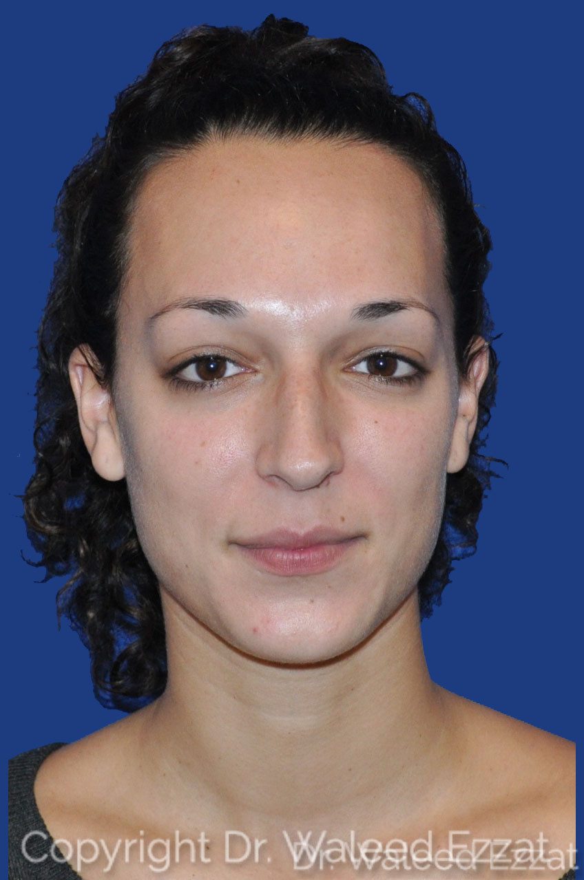 Mediterranean/Middle Eastern Rhinoplasty Patient Photo - Case 2 - before view-1