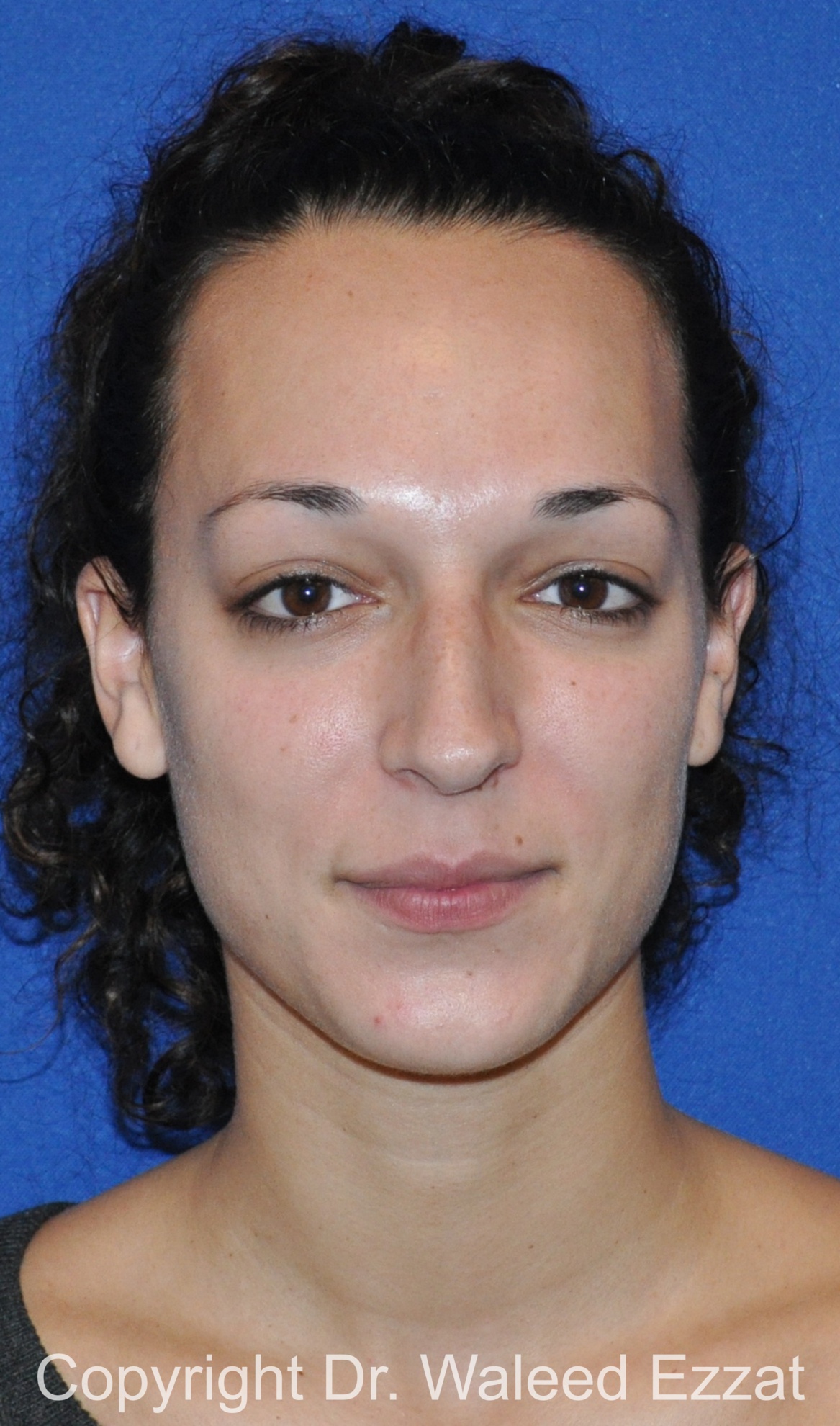 Mediterranean/Middle Eastern Rhinoplasty Patient Photo - Case 655 - before view-2