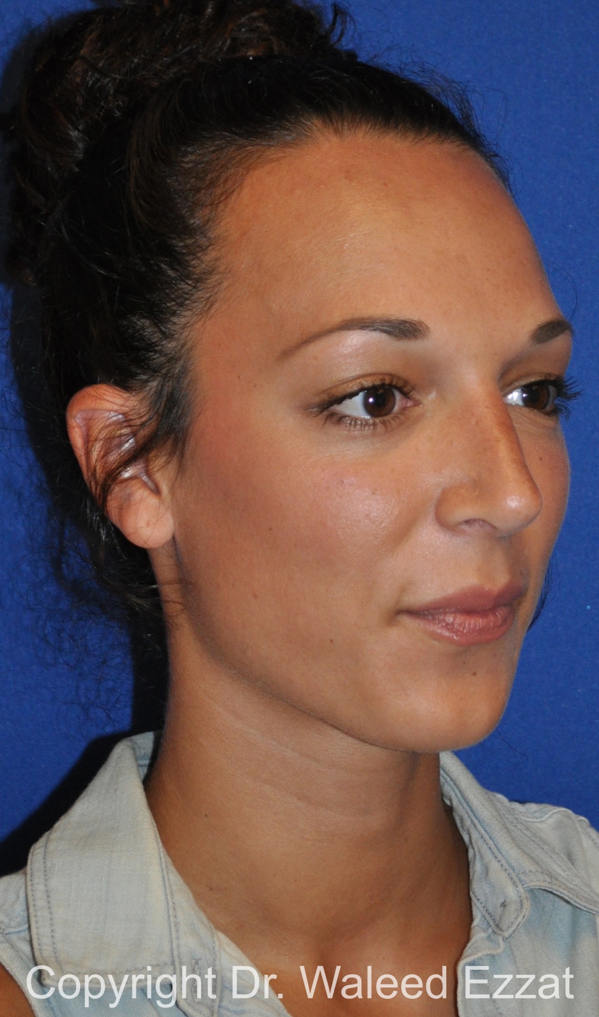 Mediterranean/Middle Eastern Rhinoplasty Patient Photo - Case 655 - after view-1