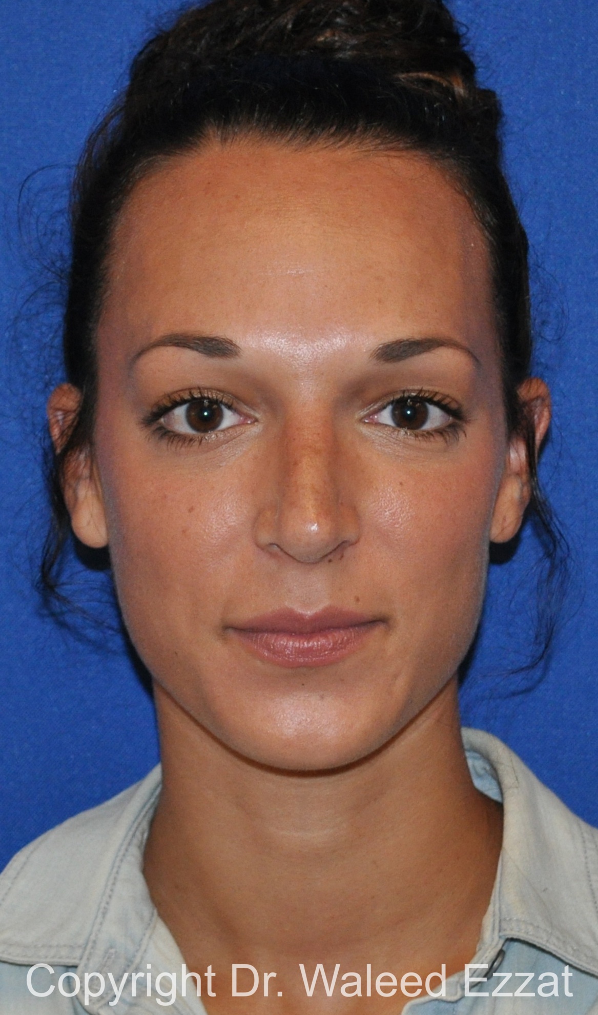 Mediterranean/Middle Eastern Rhinoplasty Patient Photo - Case 655 - after view-2