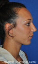 Mediterranean/Middle Eastern Rhinoplasty - Case 655 - After