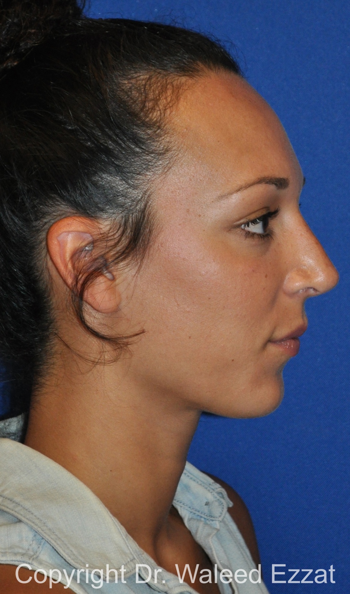 Mediterranean/Middle Eastern Rhinoplasty Patient Photo - Case 655 - after view