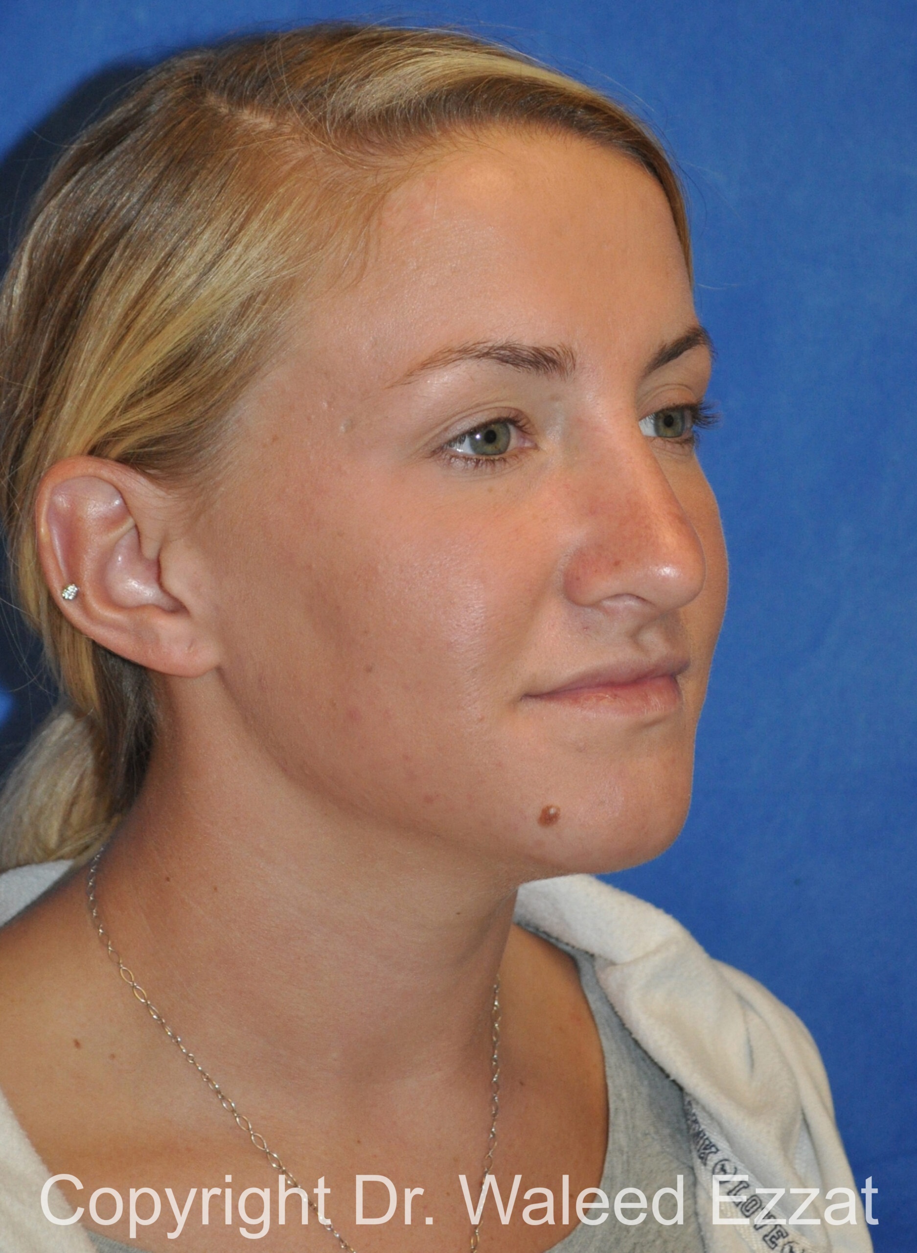 Caucasian/European Rhinoplasty Patient Photo - Case 83 - after view-1