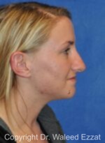 Caucasian/European Rhinoplasty - Case 83 - Before