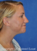 Caucasian/European Rhinoplasty - Case 83 - After