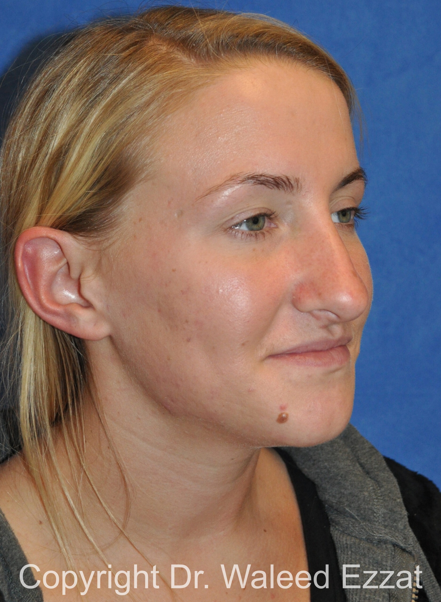 Caucasian/European Rhinoplasty Patient Photo - Case 83 - before view-1