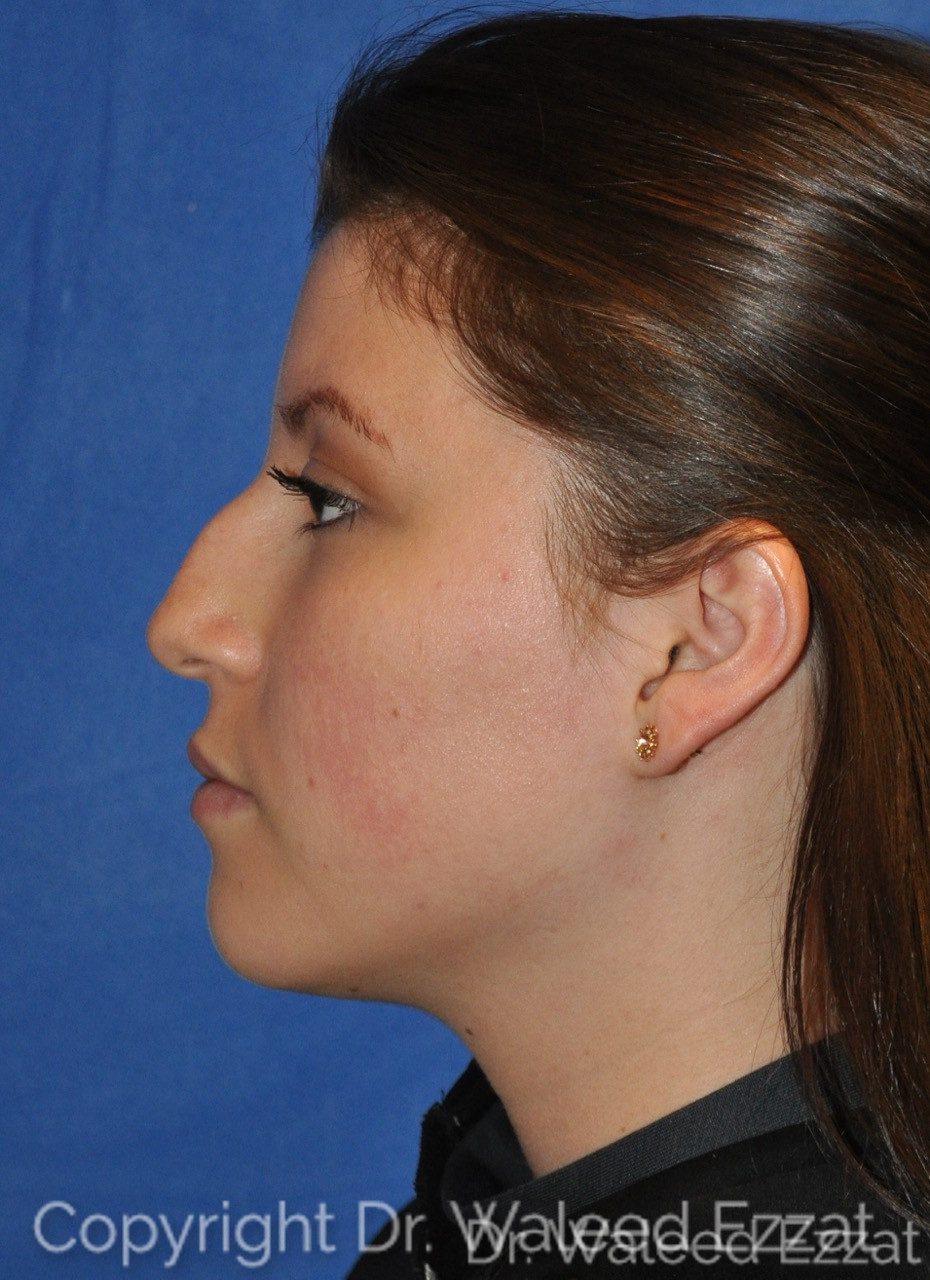 Hispanic/South American Rhinoplasty Patient Photo - Case 5 - before view-0