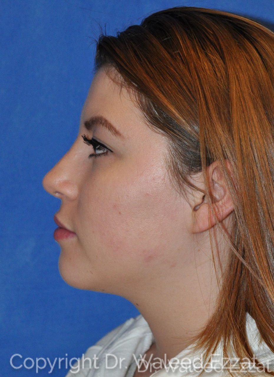 Hispanic/South American Rhinoplasty Patient Photo - Case 5 - after view