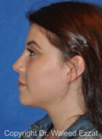 Hispanic/South American Rhinoplasty - Case 293 - After