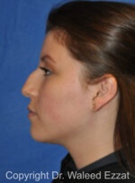Hispanic/South American Rhinoplasty - Case 293 - Before