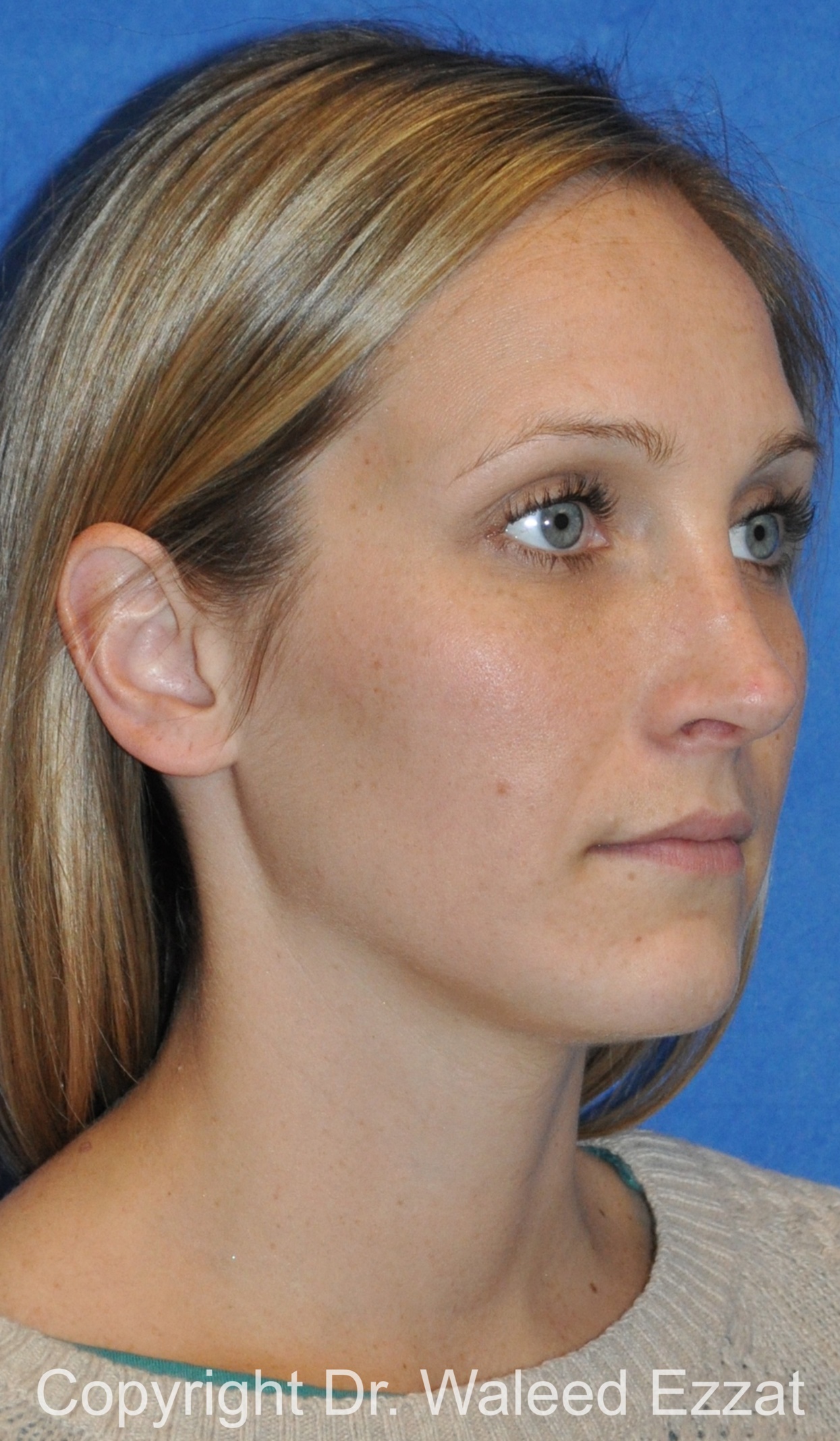 Rhinoplasty Patient Photo - Case 86 - after view-1