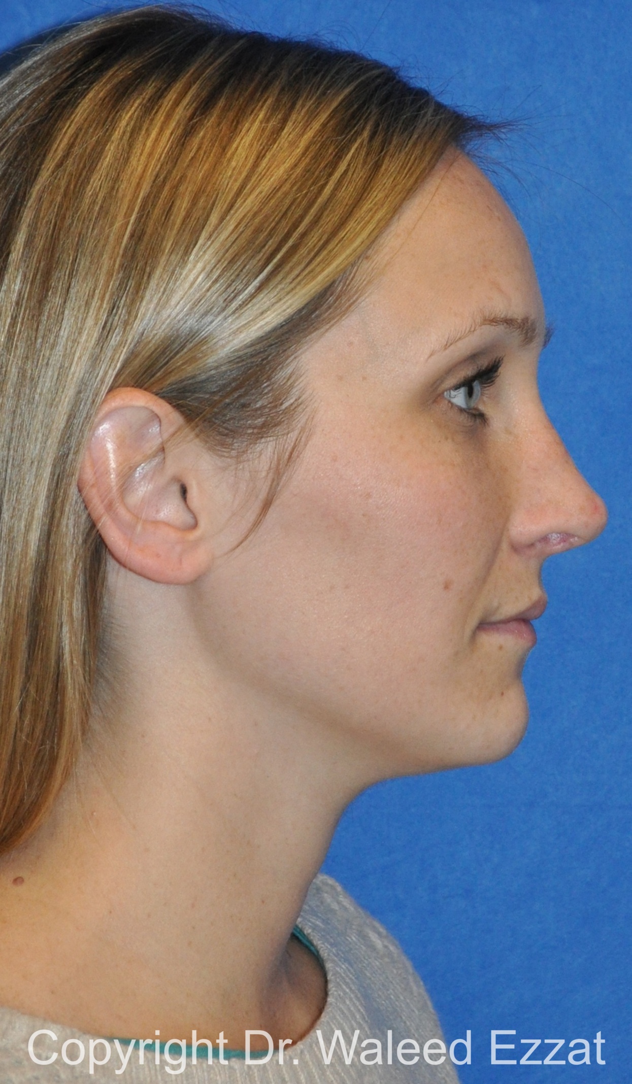 Rhinoplasty Patient Photo - Case 86 - after view