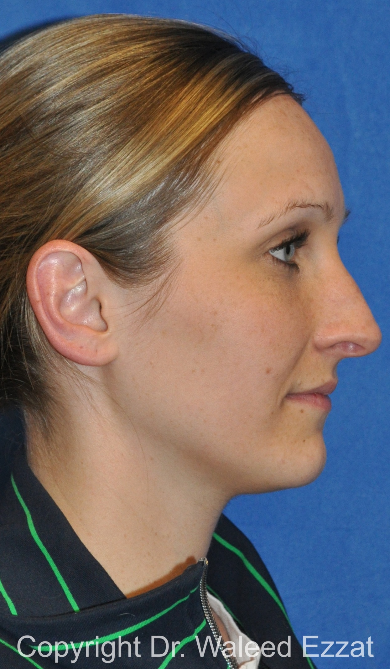 Rhinoplasty Patient Photo - Case 86 - before view-