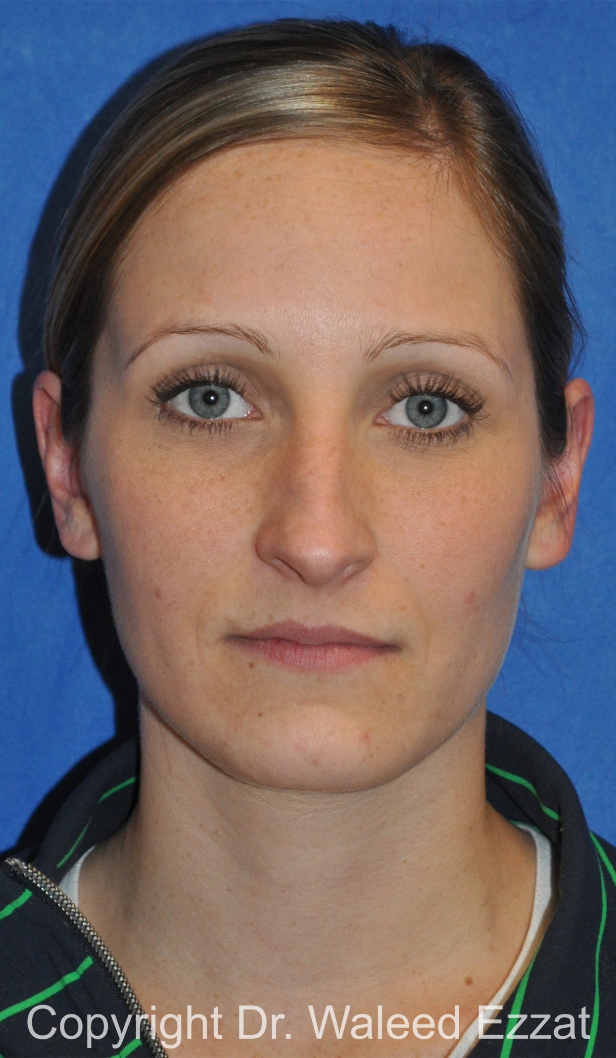 Rhinoplasty Patient Photo - Case 86 - before view-2