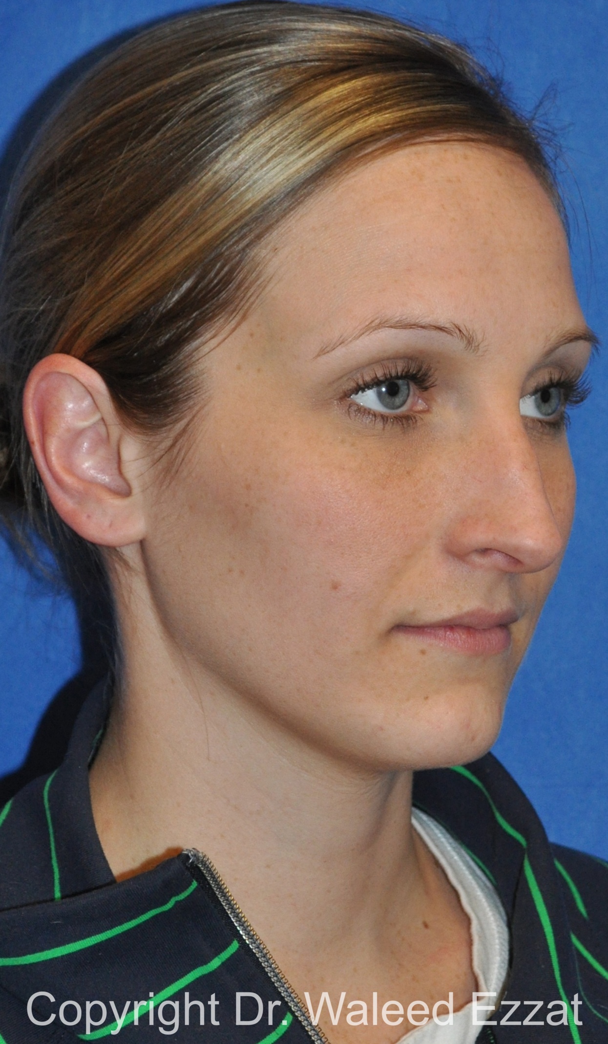 Rhinoplasty Patient Photo - Case 86 - before view-1