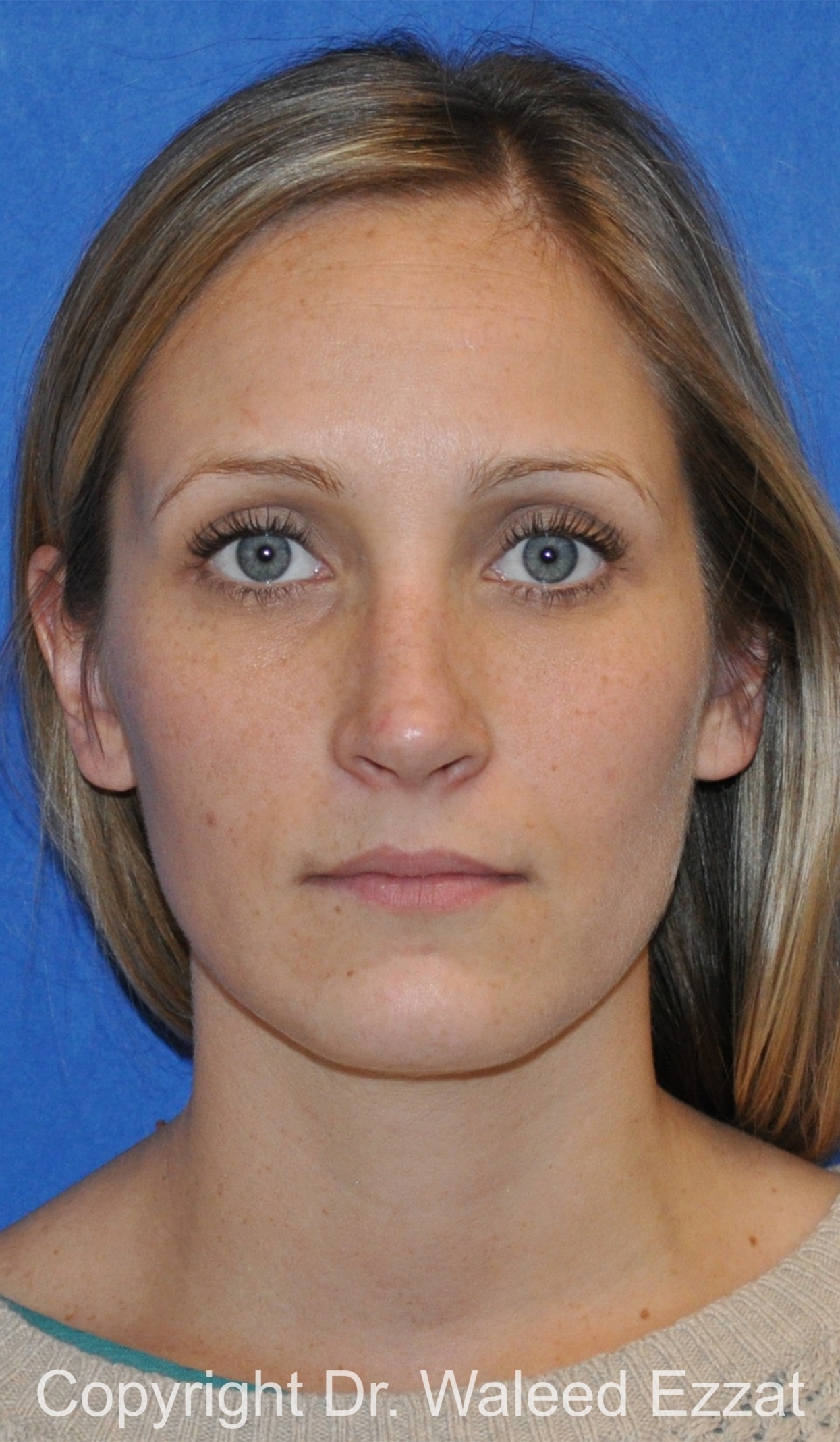 Rhinoplasty Patient Photo - Case 86 - after view-2