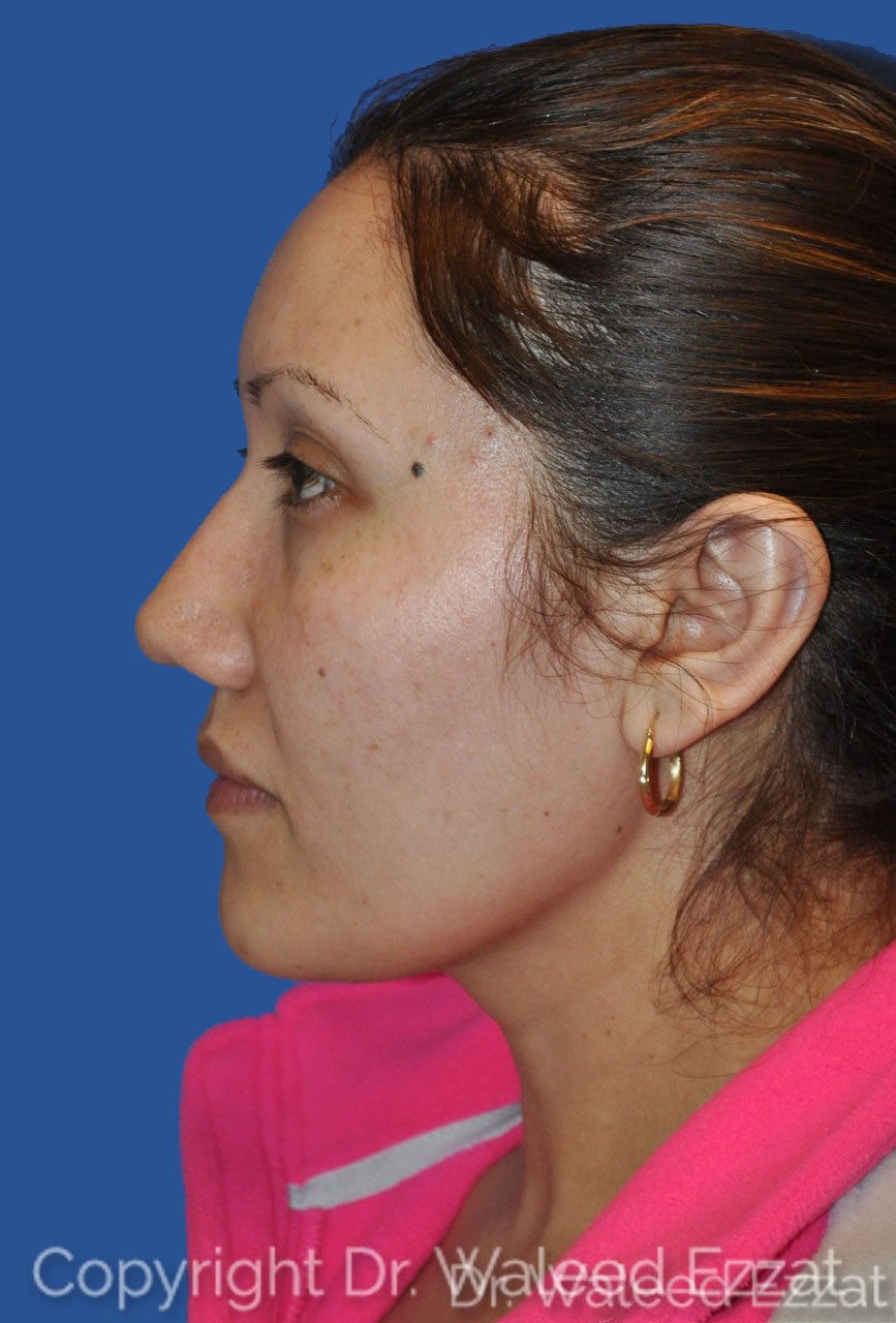 Hispanic/South American Rhinoplasty Patient Photo - Case 21 - after view-0