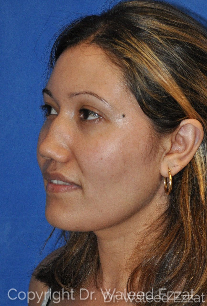 Hispanic/South American Rhinoplasty Patient Photo - Case 21 - before view-1