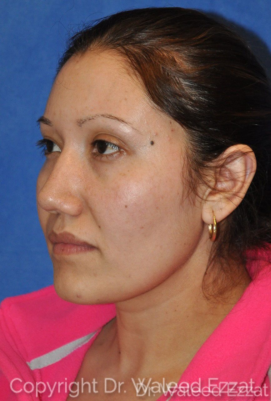 Hispanic/South American Rhinoplasty Patient Photo - Case 21 - after view-1