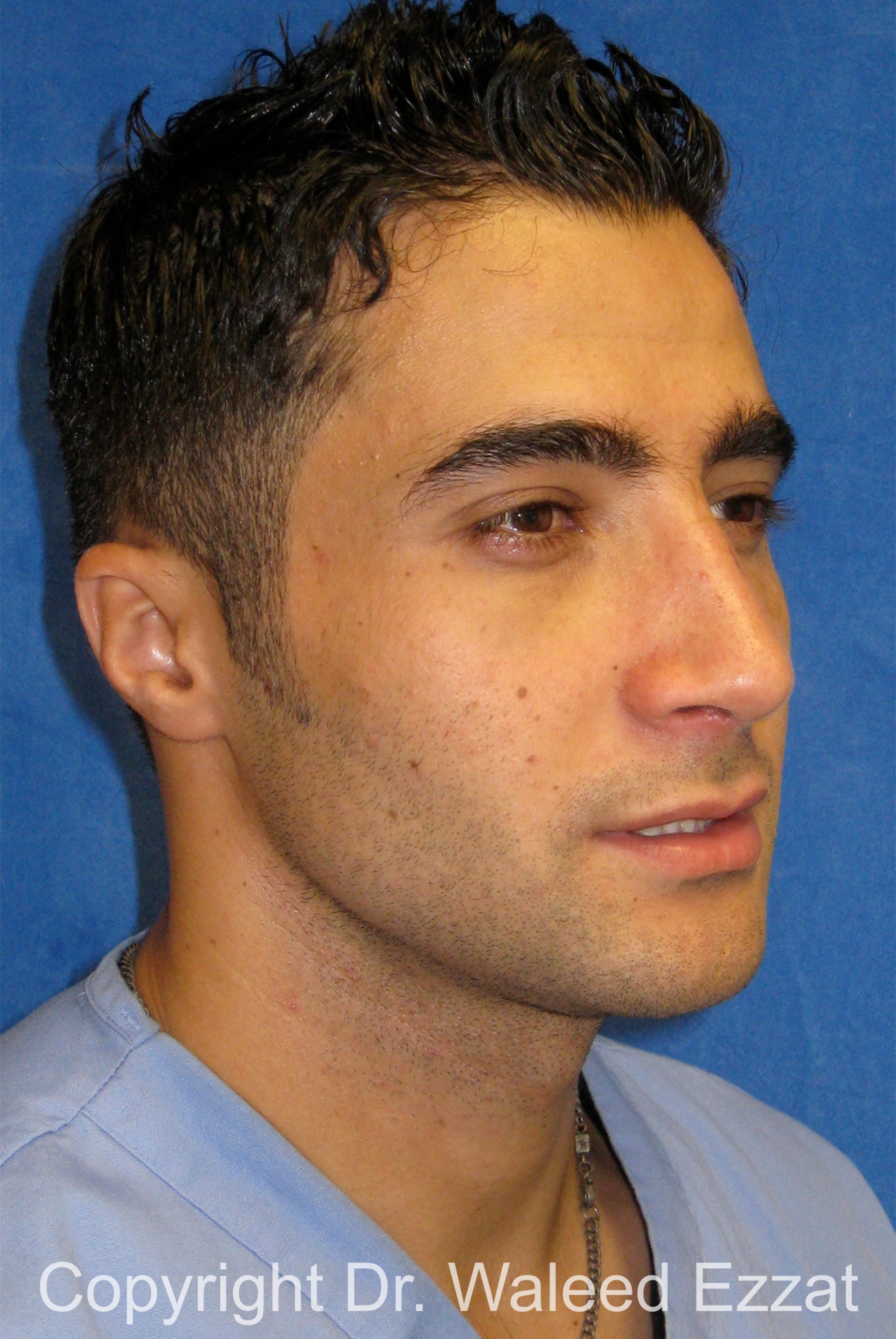 Male Rhinoplasty Patient Photo - Case 61 - after view-1