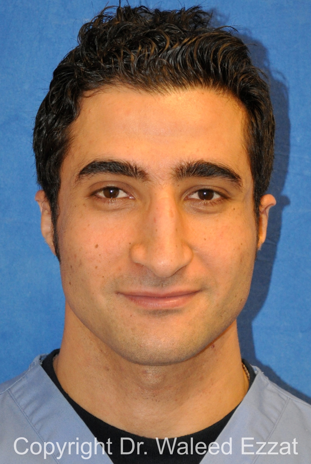 Male Rhinoplasty Patient Photo - Case 61 - before view-2