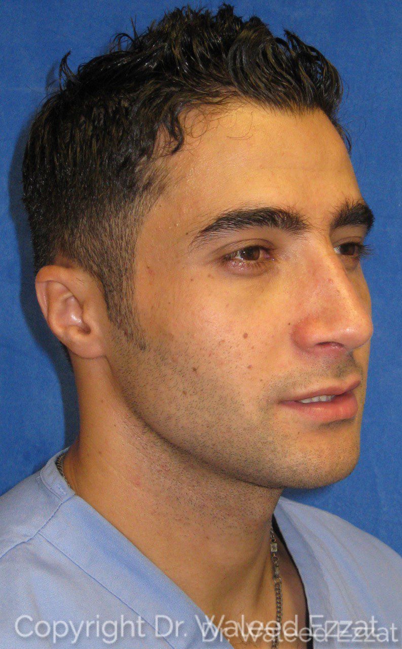 Male Rhinoplasty Patient Photo - Case 26 - after view-2