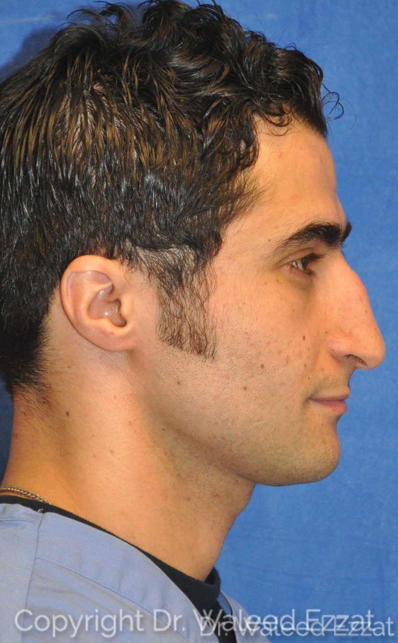 Male Rhinoplasty Patient Photo - Case 26 - before view-