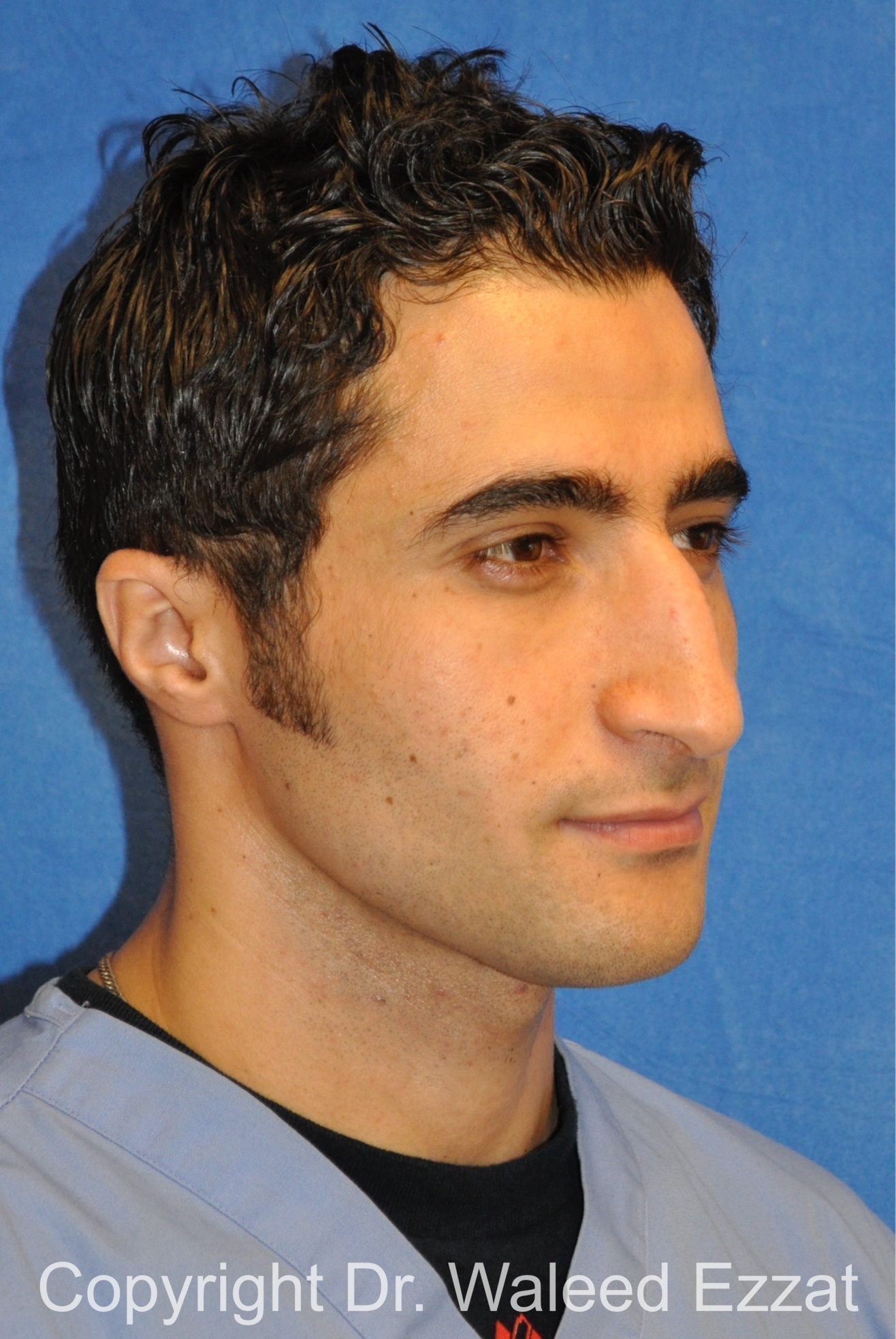 Male Rhinoplasty Patient Photo - Case 61 - before view-1