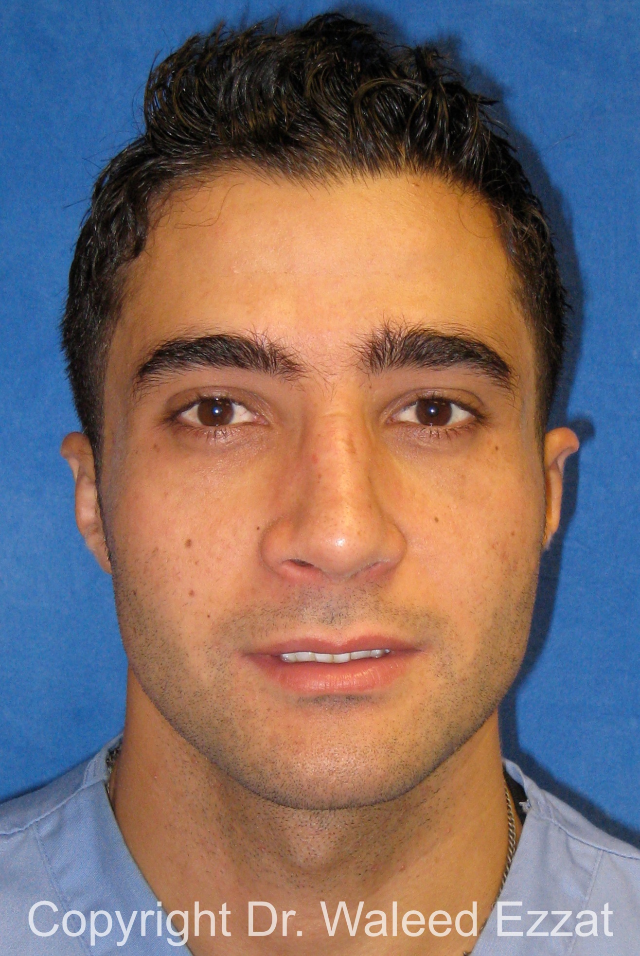 Male Rhinoplasty Patient Photo - Case 61 - after view-2