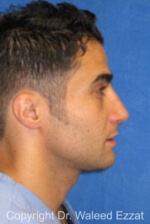 Male Rhinoplasty - Case 61 - After