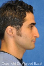 Male Rhinoplasty - Case 61 - Before