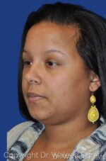 Neck Lift - Case 19 - Before