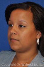 Neck Lift - Case 19 - After