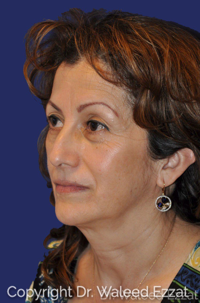 Cheek Lift Patient Photo - Case 2 - before view-1
