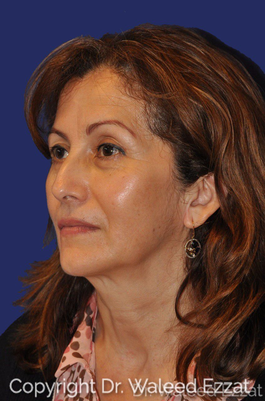 Cheek Lift Patient Photo - Case 2 - after view-1